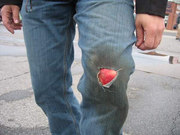 Yeah it hurts worse then it looks!